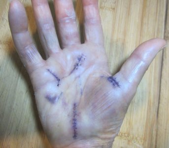 Stitches removed from Right hand 11-14-24.jpg Stitches removed from Right hand 11-14-24.jpg