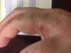 fire ant bite.jpg