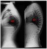 scheuremanns-kyphoiss-story-xray (1).jpg